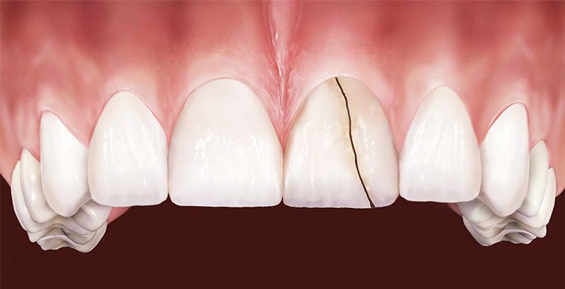 Dentes Quebrados Podem Gerar Infecção? Entenda os Riscos e Como Prevenir Complicações